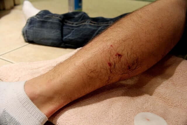 A dog bite wound on a patient's left leg.